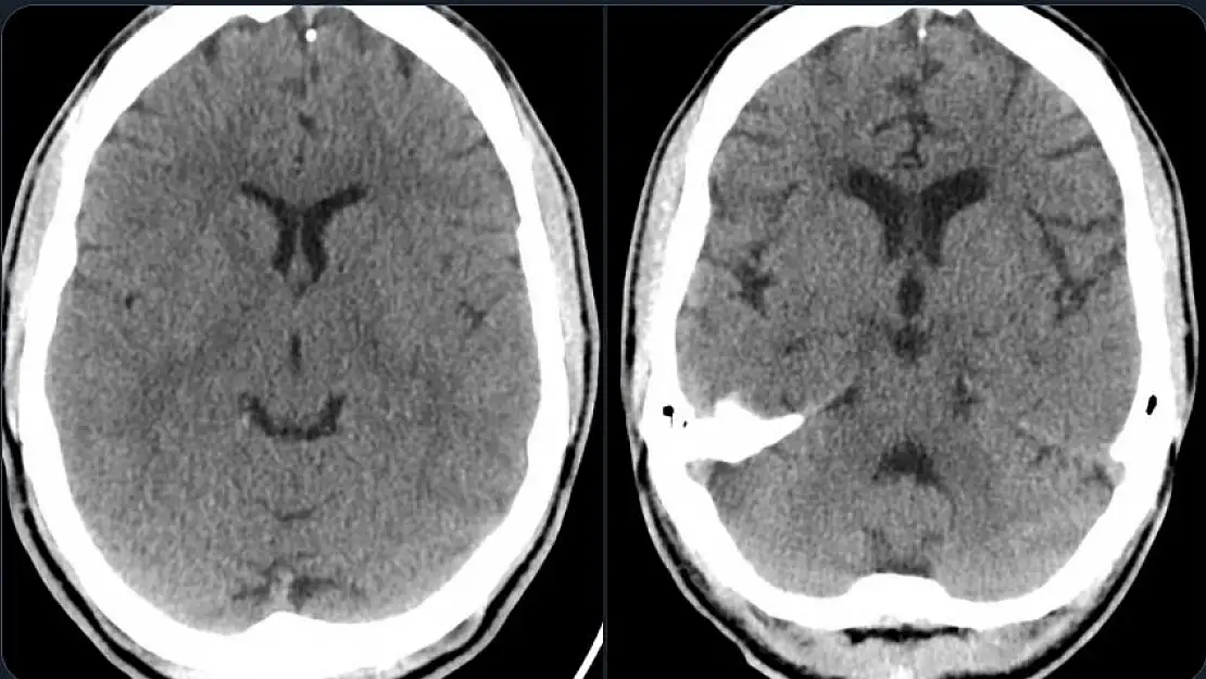 3 yıl arayla çekilmiş beyin tomografisi şoke etti!