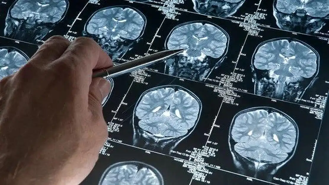 Alzheimer hastaları için müzik terapisi etkili olabilir