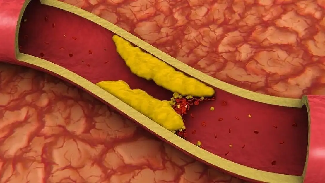 Damar tıkanıklığı neden olur?
