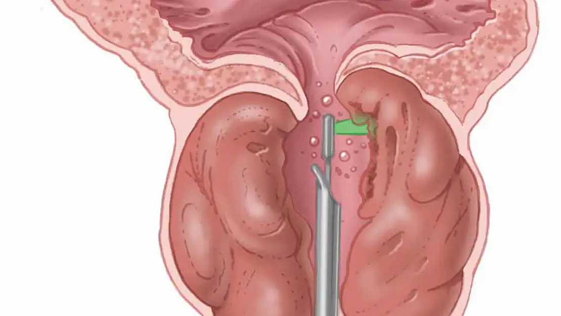 İyi huylu prostat büyümesinde HoLEP yöntemi
