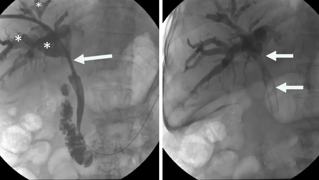 İzmir 'de çığır açan safra yolu tedavisi