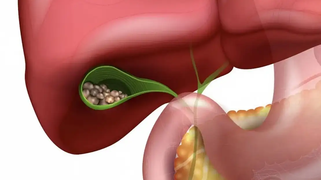 Sessiz tehlike! Safra kesesi taşları hangi hastalıklara yol açıyor?