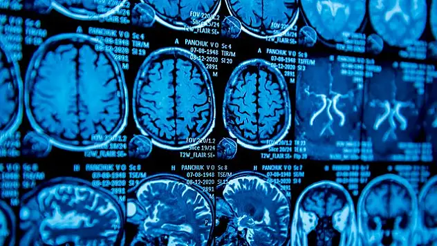Genç yaşta Parkinson vakaları artıyor!