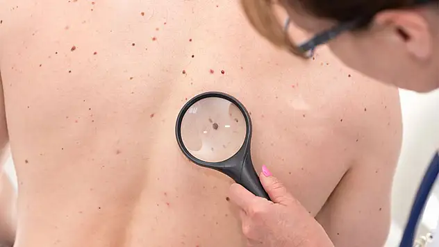 Güneşe dikkat! Cilt kanseri sessizce yayılabilir