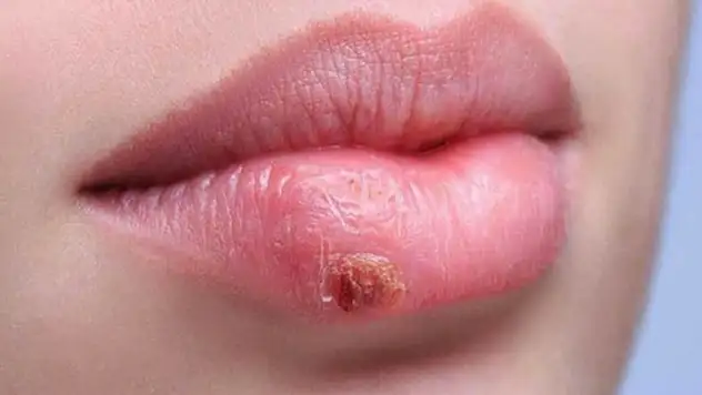 Uçuğu olanlar dikkat! Bu hastalık Alzheimer riskini artırıyor!